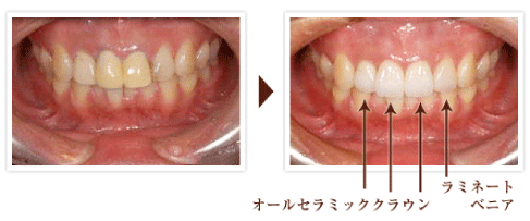 セラミックインレーの画像
